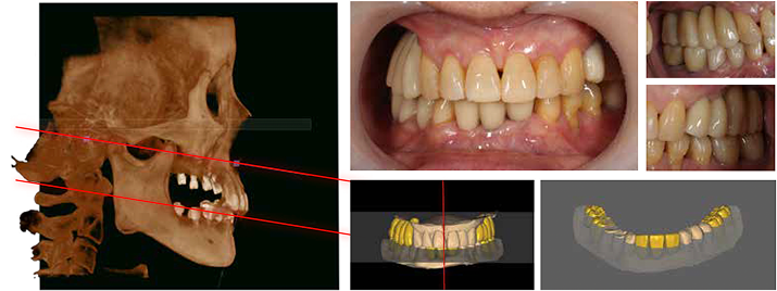 AI Occlusal Plane