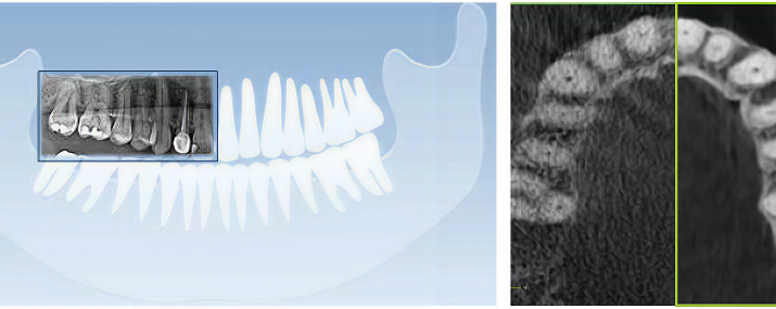 AI Occlusal Plane