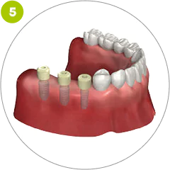 Step 5